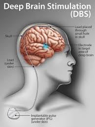 Deep Brain Stimulation (DBS) - Image 3