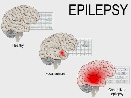 Epilepsy Surgery - Image 2