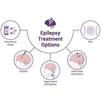Epilepsy Surgery - Image 3