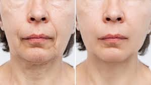 Facelift Surgery - Rhytidectomy - Image 2