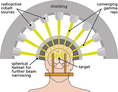 Gamma Knife Surgery