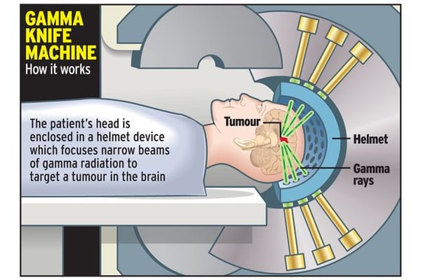 Gamma Knife Surgery - Image 2