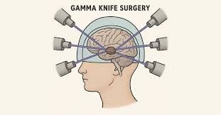 Gamma Knife Surgery - Image 3