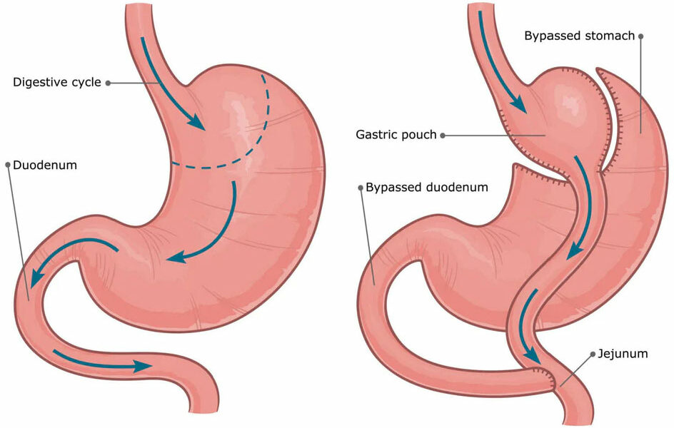 Gastric Bypass Surgery