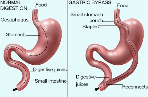 Gastric Bypass Surgery - Image 3