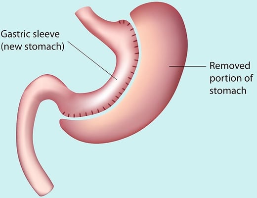 Gastric Sleeve or Sleeve Gastrectomy Surgery - Image 2