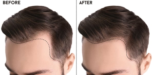 Hair Transplant