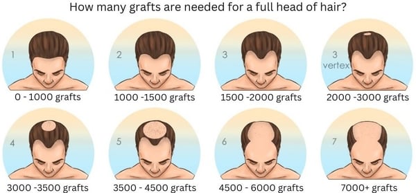 Hair Transplant - Image 2