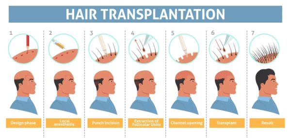 Hair Transplant - Image 3