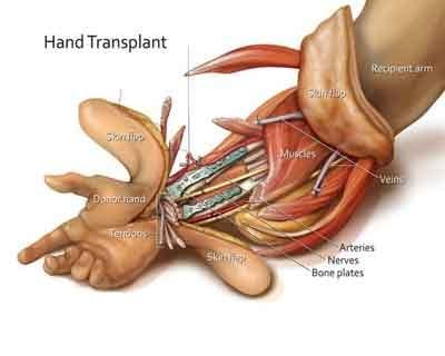 Hand Transplant - Image 3