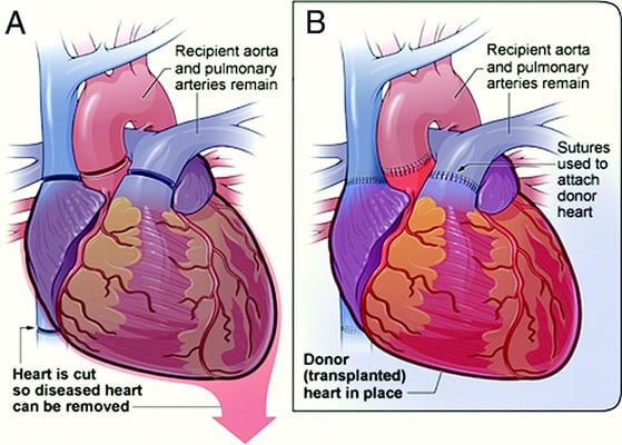 Heart Transplant - Image 3