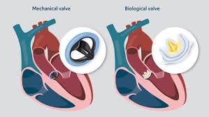 Heart Valve Replacement - Image 2