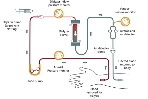 Hemodialysis - Image 2