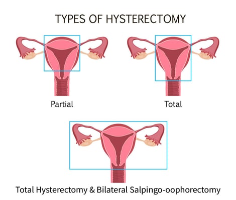 Hysterectomy