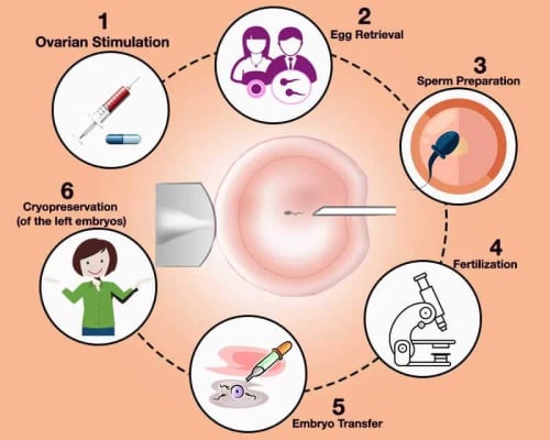 ICSI Treatment -  Intracytoplasmic Sperm Injection