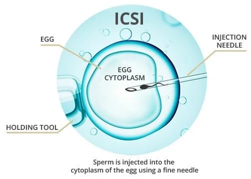 ICSI Treatment -  Intracytoplasmic Sperm Injection - Image 3