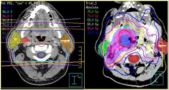 Intensity-Modulated Radiotherapy (IMRT) - Image 2