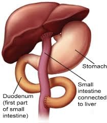 Kasai Procedure - Image 3