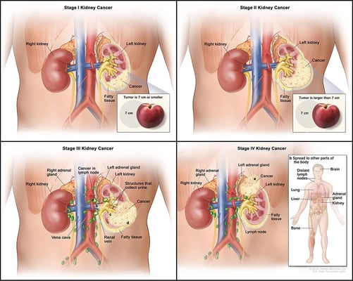 Kidney Cancer Treatment