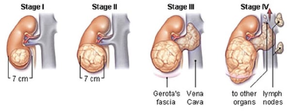 علاج سرطان الكلى - Image 2