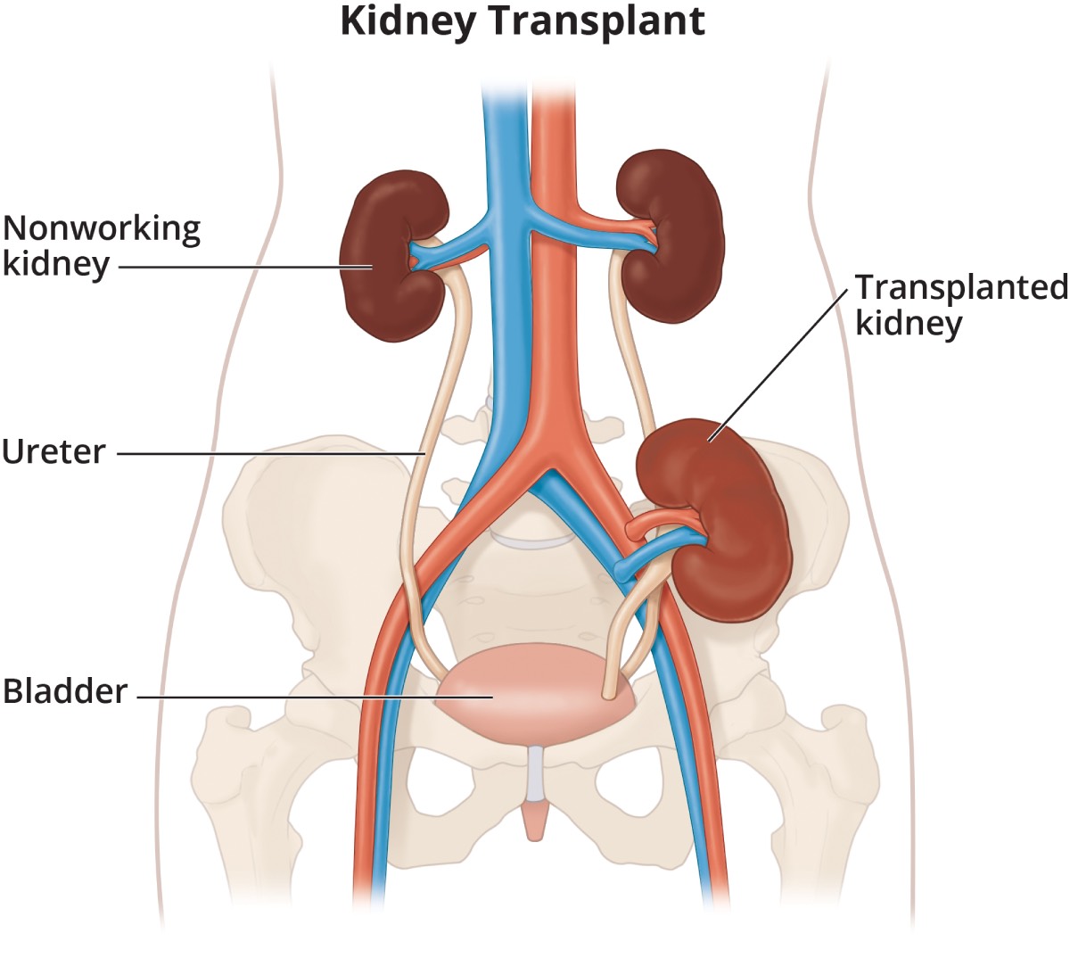 Kidney Transplant - Image 2