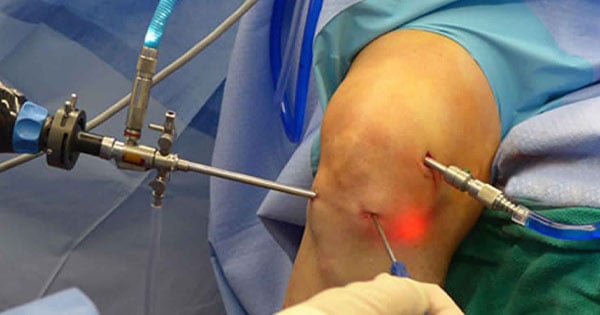 Knee Arthroscopy - Image 2