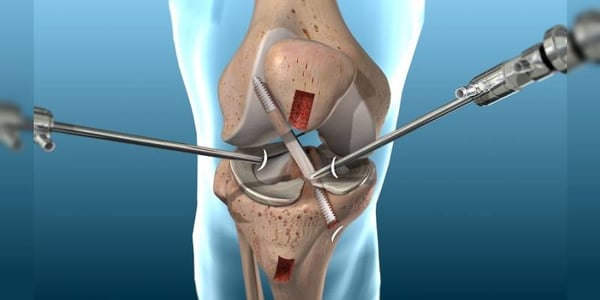 Knee Arthroscopy - Image 3