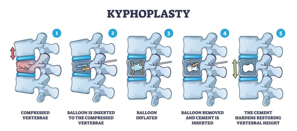 Kyphoplasty