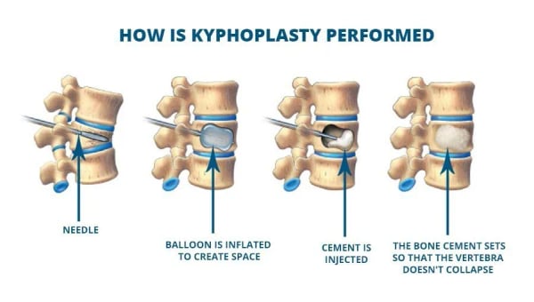 Kyphoplasty - Image 3
