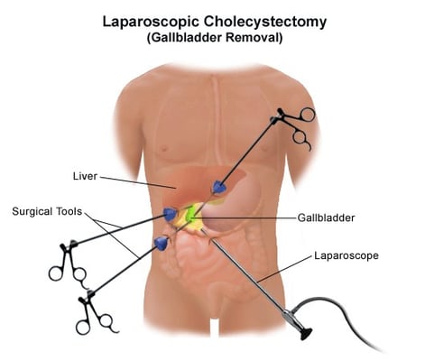 Laparoscopic Cholecystectomy - Gallbladder Removal