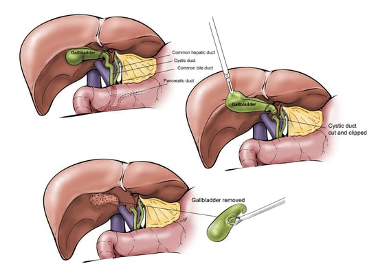 Laparoscopic Cholecystectomy - Gallbladder Removal - Image 3