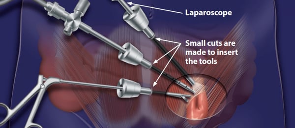 Laparoscopic Hernia Surgery - Image 2