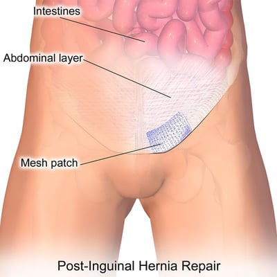 Laparoscopic Hernia Surgery - Image 3