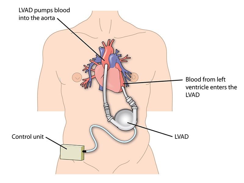 Left Ventricular Assist Device - LVAD