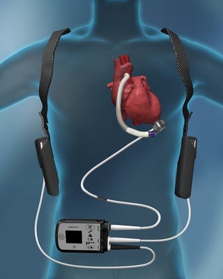 Left Ventricular Assist Device - LVAD - Image 2
