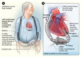 Left Ventricular Assist Device - LVAD - Image 3