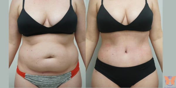 Liposuction - Image 2