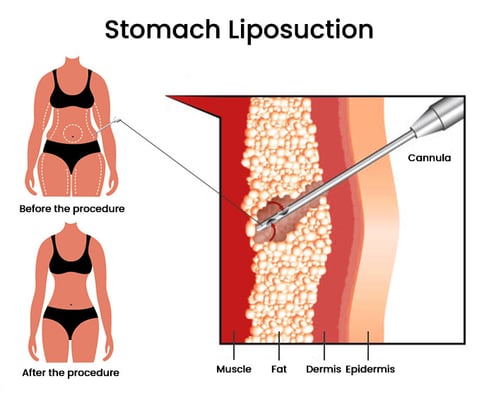 Liposuction - Image 3
