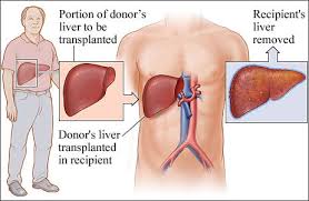 Liver Transplant