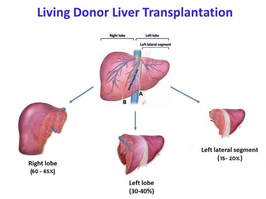 Liver Transplant - Image 2