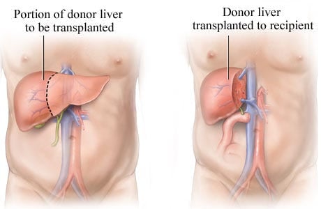 Liver Transplant - Image 3