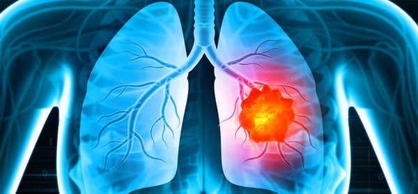 Lung Cancer Treatment