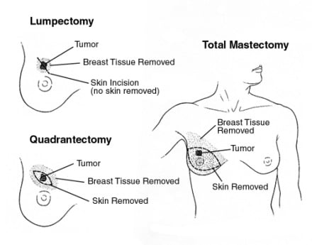 Mastectomy