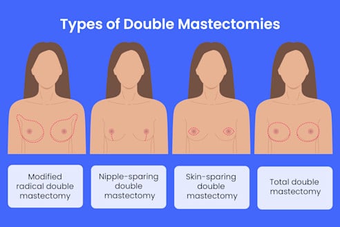 Mastectomy - Image 2