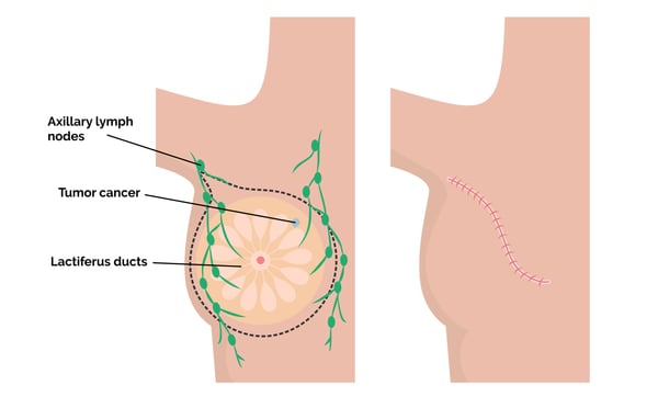 Mastectomy - Image 3