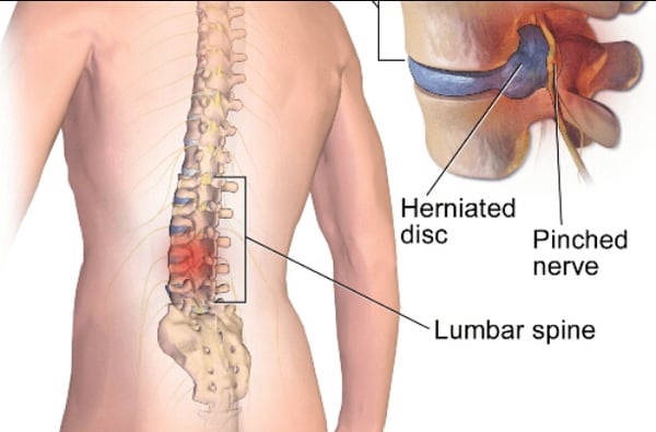 Microdiscectomy Surgery