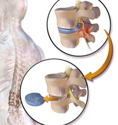 Microdiscectomy Surgery - Image 2