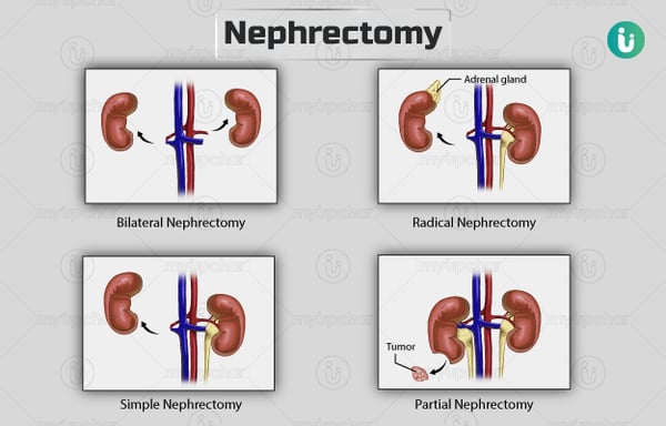Nephrectomy - Image 2