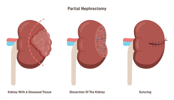 Nephrectomy - Image 3