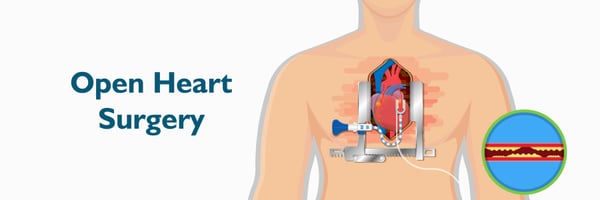 Open Heart Surgery